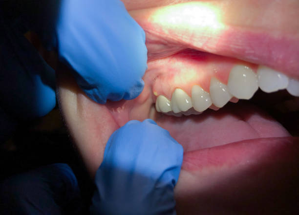 Best Emergency Dental Care for Broken or Chipped Teeth in St George, SC