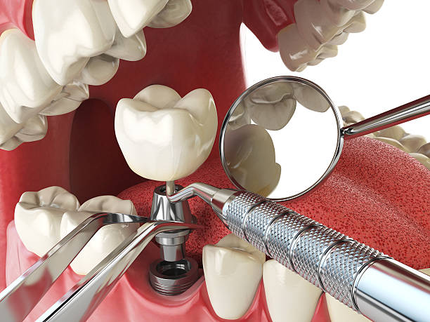 Best Emergency Treatment for Dental Infections or Abscesses in St George, SC