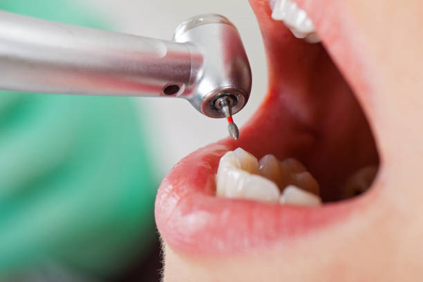 Best Emergency Dental Care for Broken or Chipped Teeth in St George, SC